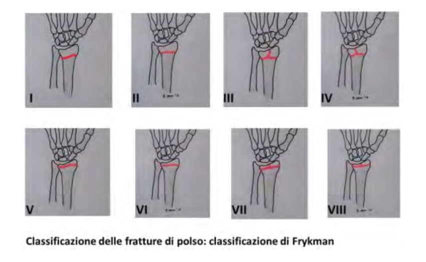 classificazione fratture classificazione fratture
