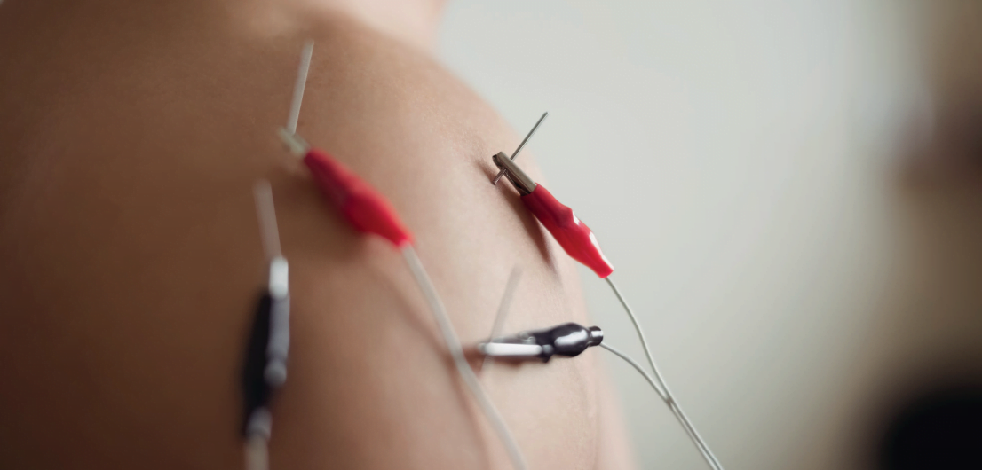 agopuntura agopuntura