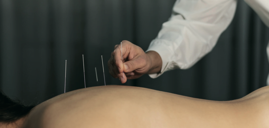 agopuntura